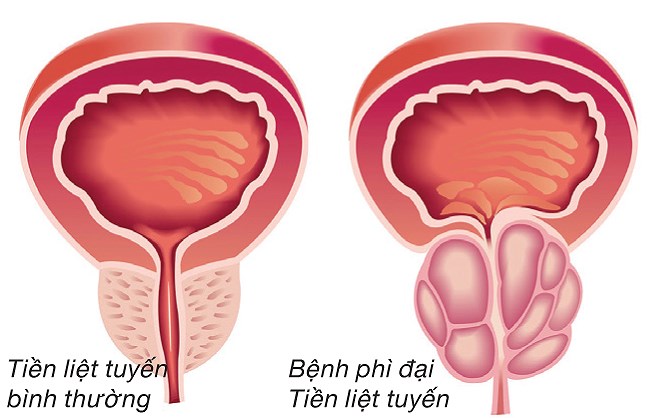 Bệnh phì đại tiền liệt tuyến